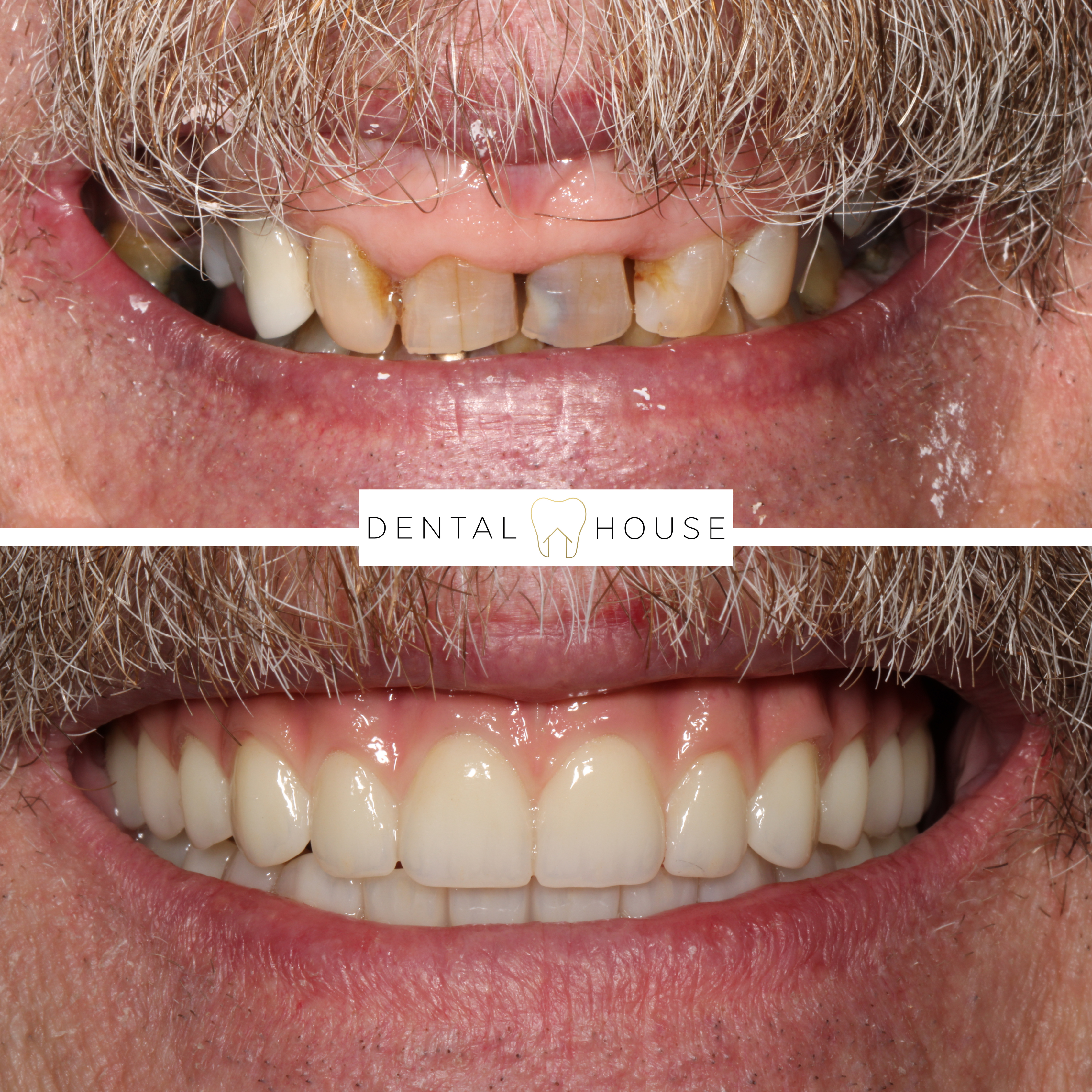 Dental House patient before and after full-arch implant treatment