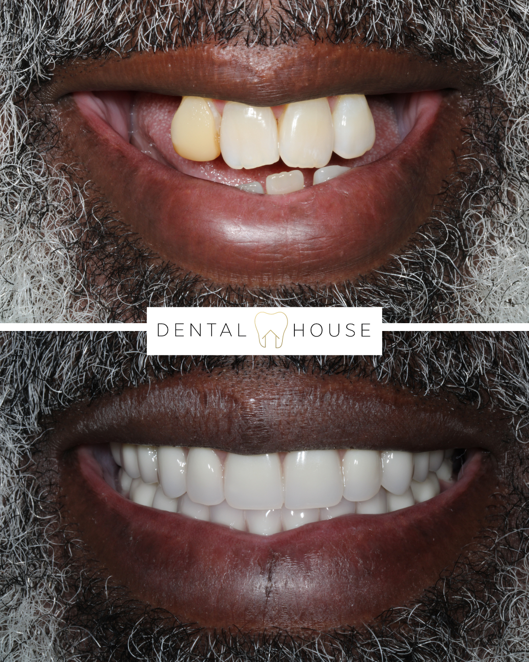 Dental House patient before and after full-arch implant treatment