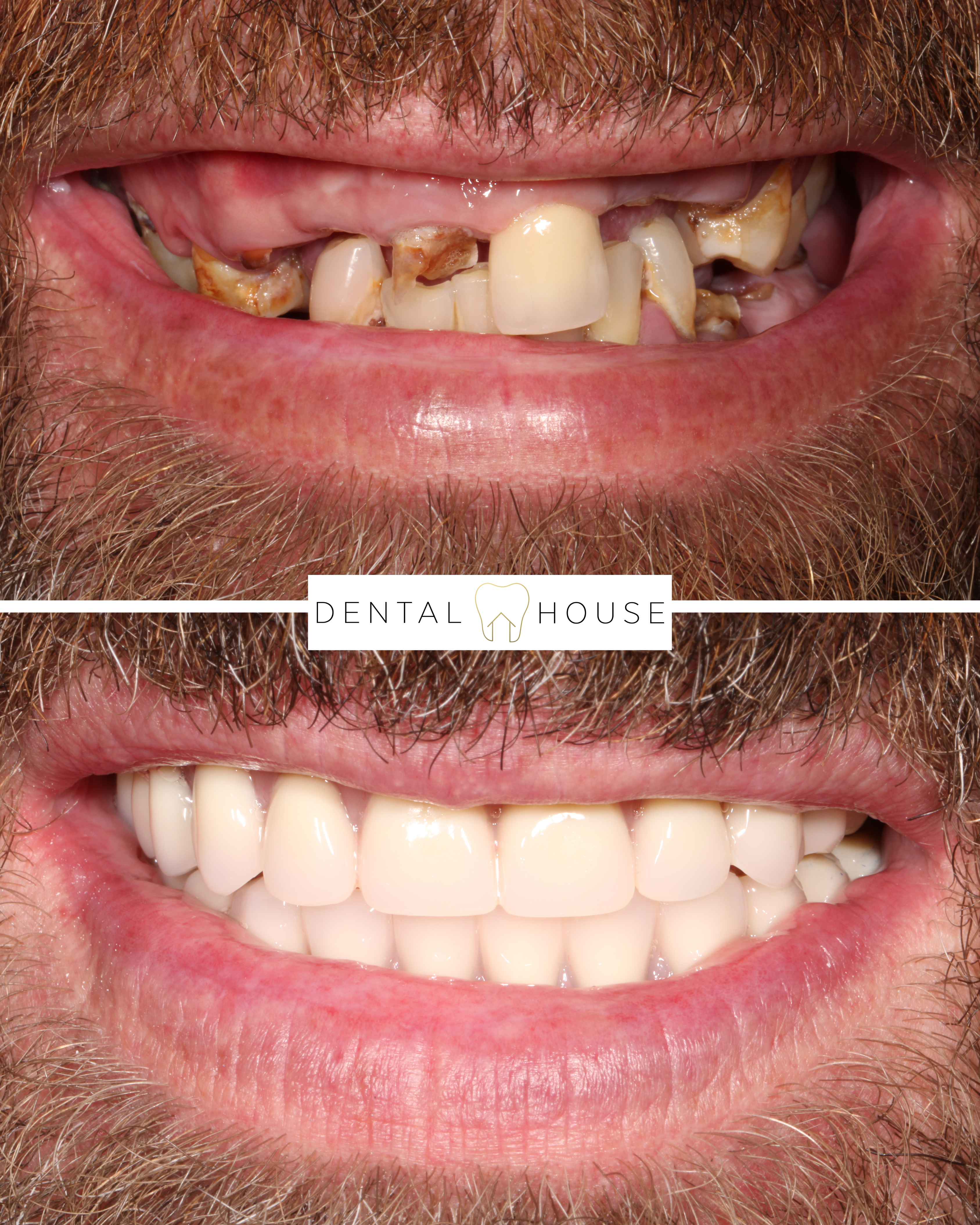 Dental House patient before and after full-arch implant treatment