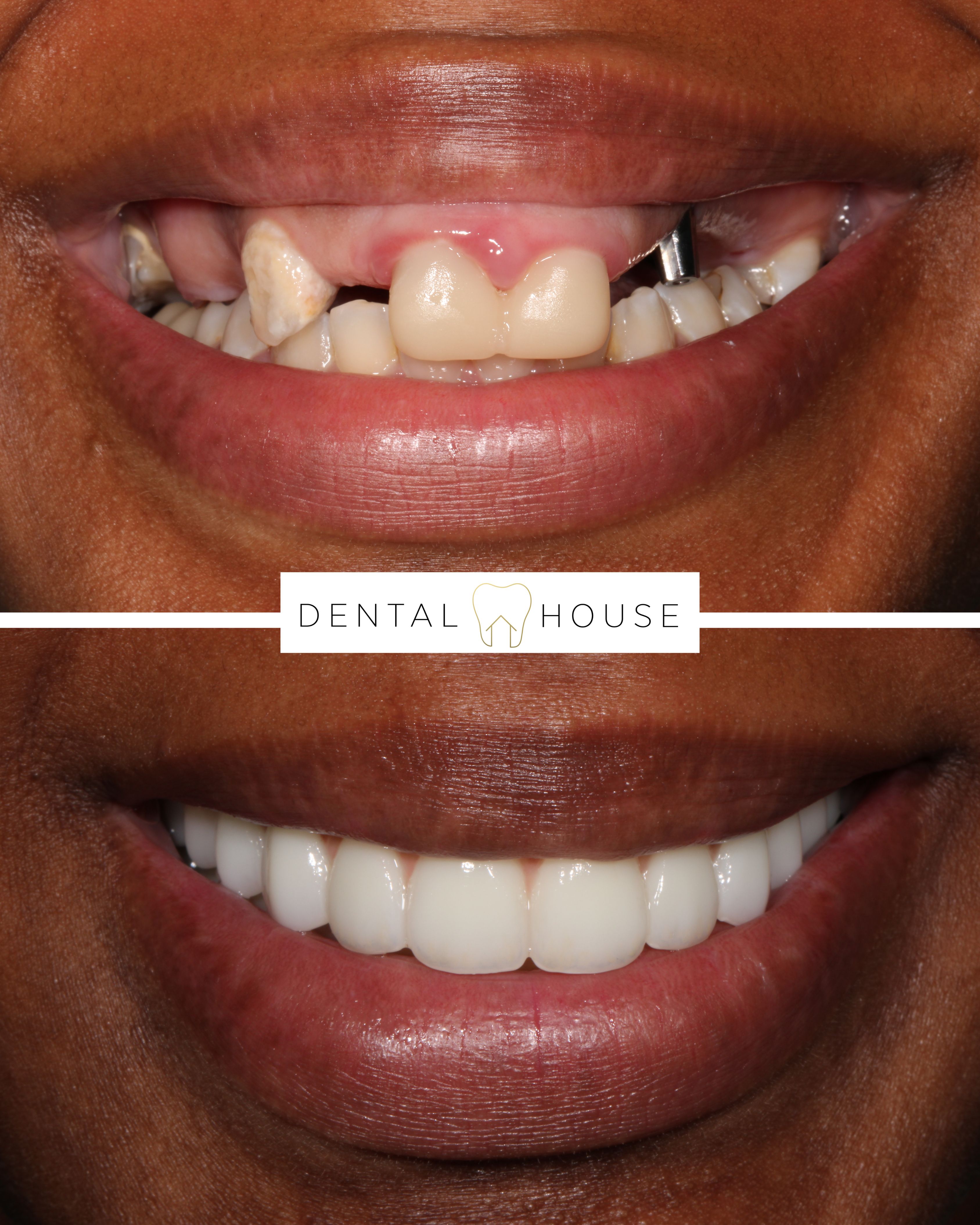 Dental House patient before and after full-arch implant treatment