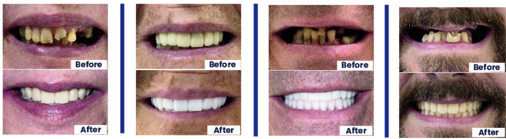 Before and after dental implant results for four Dental House patients