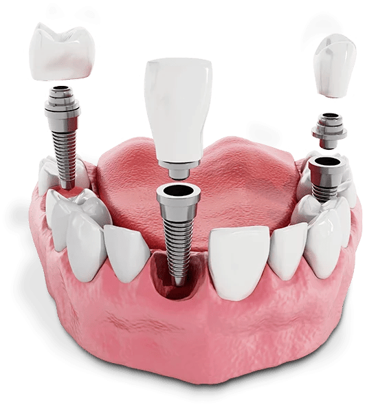Single tooth dental implant model