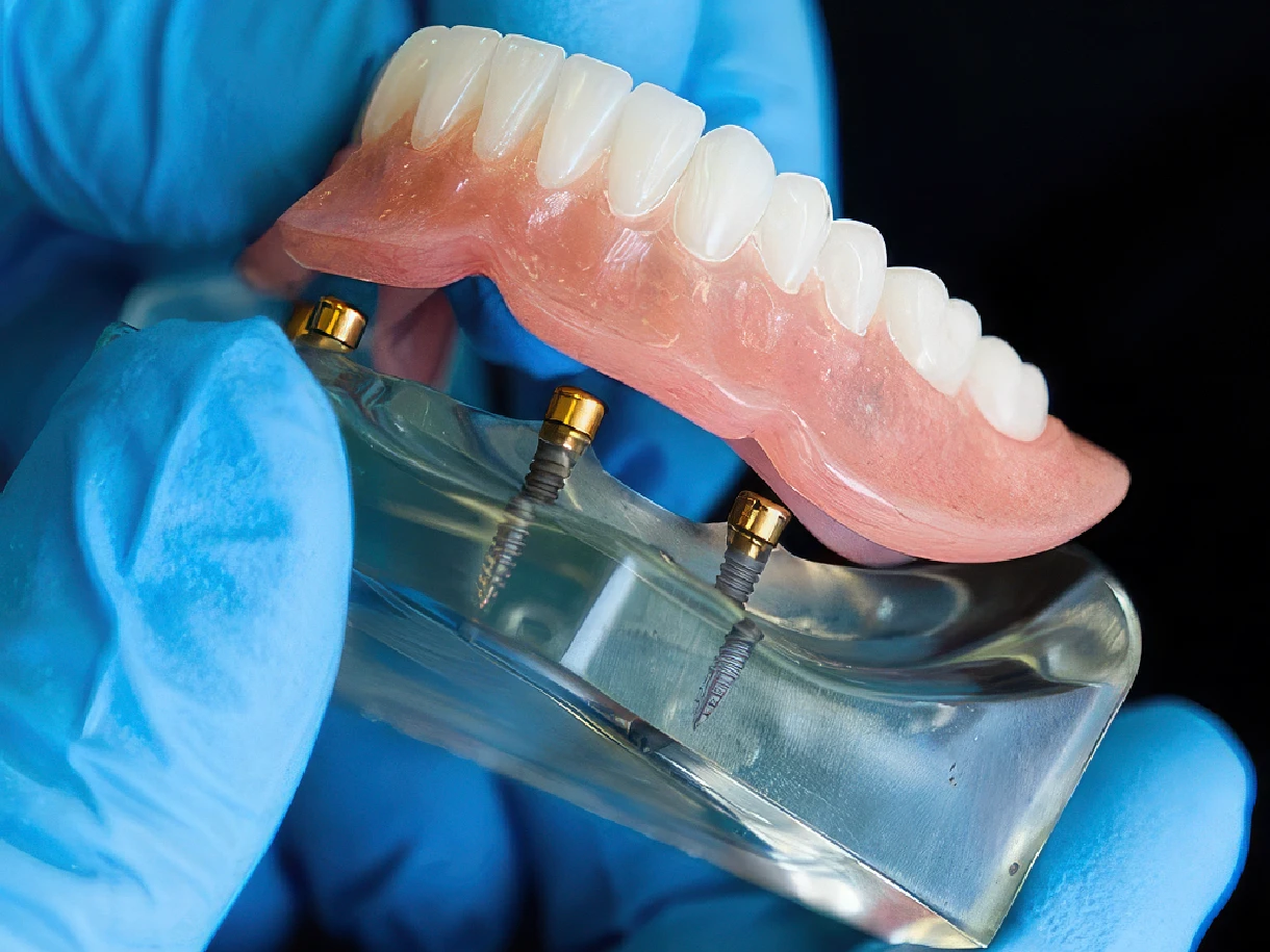 Implant-supported full arch restoration